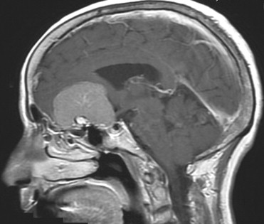 Anterior fossa meningiomas: a review of the clinical feature...